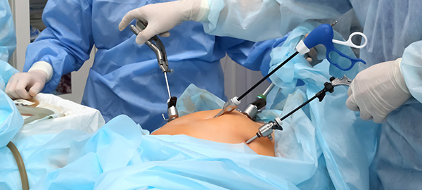 laparoscopic-surgery